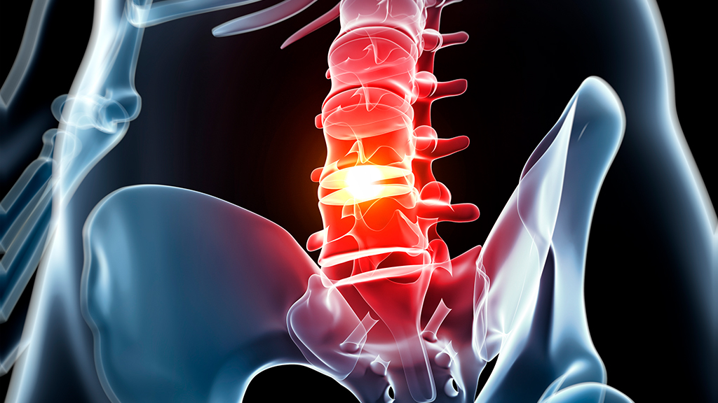 Degenerative Disc Disease  Spinal Decompression Livermore